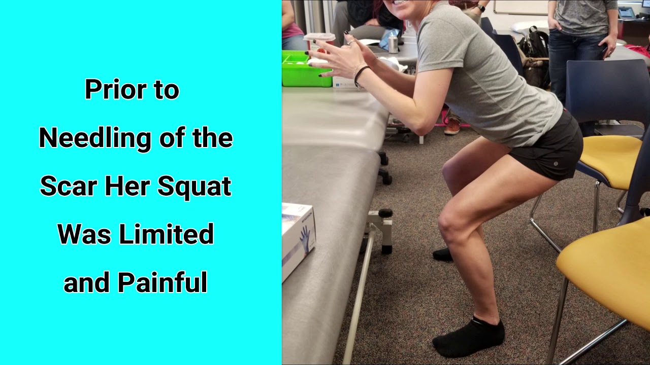 Scar Dry Needling Myopain Seminars