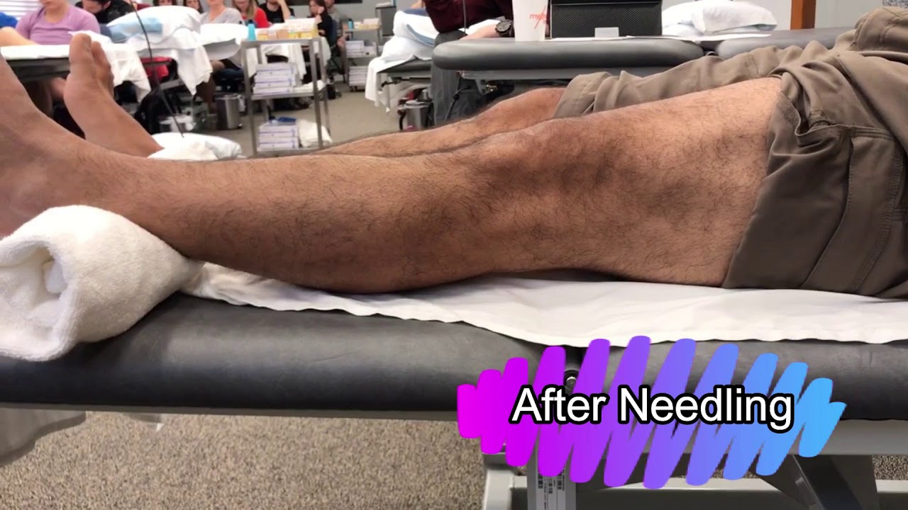 Limited knee extension Myopain Seminars