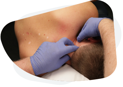 Dry needling of the neck