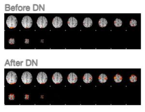Brain activity of a stroke patient with post-stroke spasticity before and after dry needling.