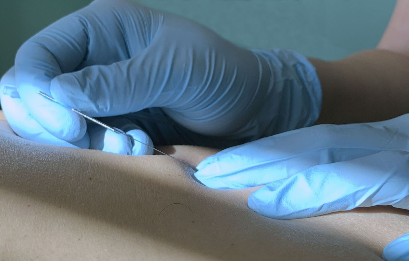 Electro-muscular Dry Needling. What is it? - Intune Sports