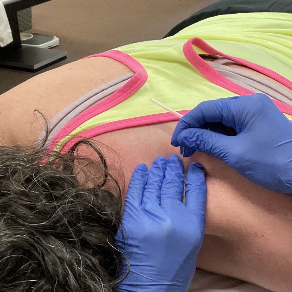 Dry needling being performed on a student at Myopain Seminars