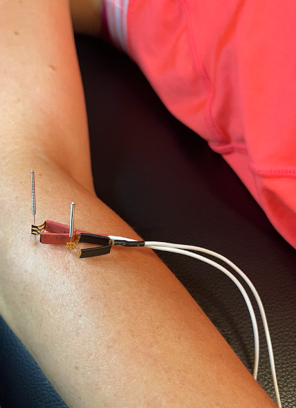 Intramuscular Electrical Stimulation for Ankle Pain, Dry needling with  intramuscular electrical stimulation for ankle pain. A lot of times, ankle  pain can be caused by other areas. In this case, tightness